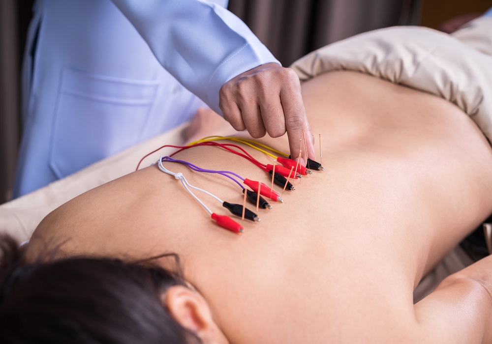 young woman undergoing acupuncture treatment with electrical stimulator on back